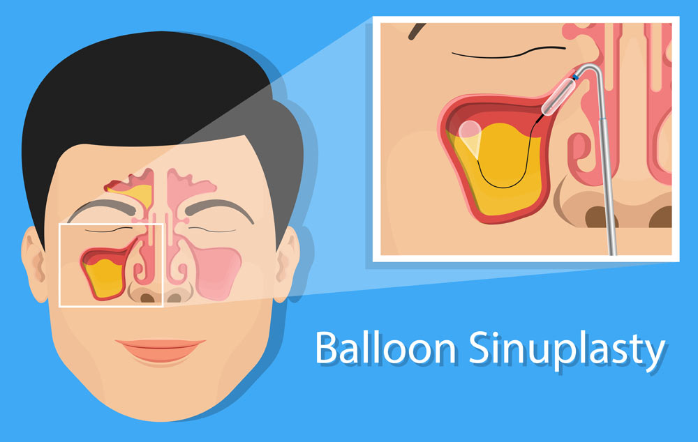 Balloon Sinuplasty art concept