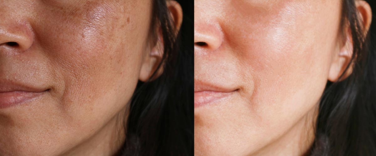 Before and after facial PicoSure treatment