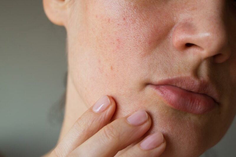 pores on the skin of the face