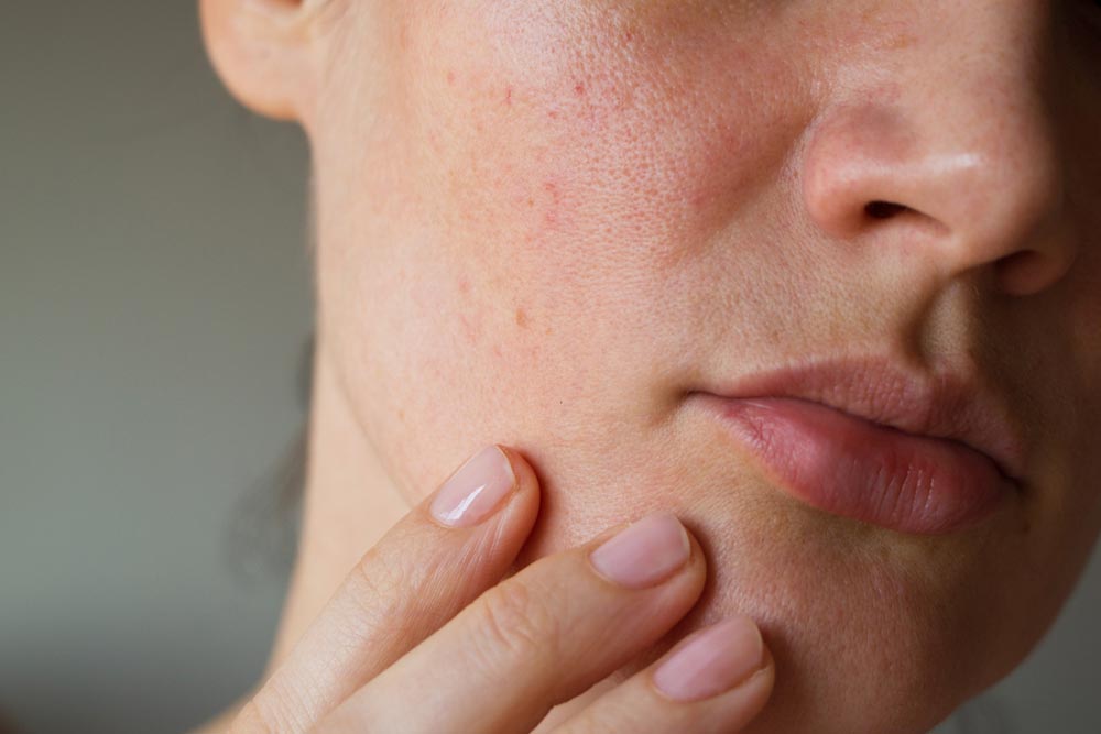 pores on the skin of the face