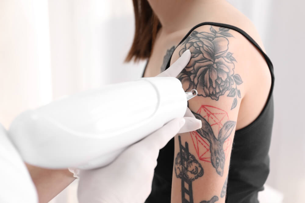 patient and professional tattoo removal laser
