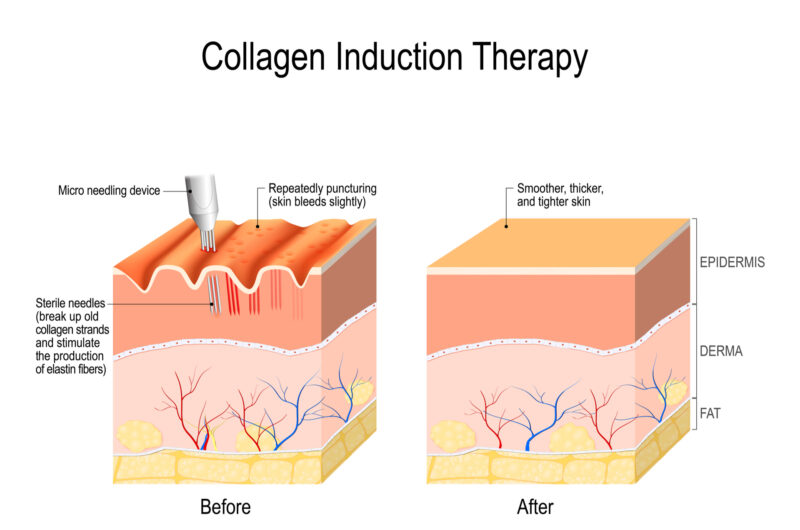Microneedling or Collagen Induction Therapy example