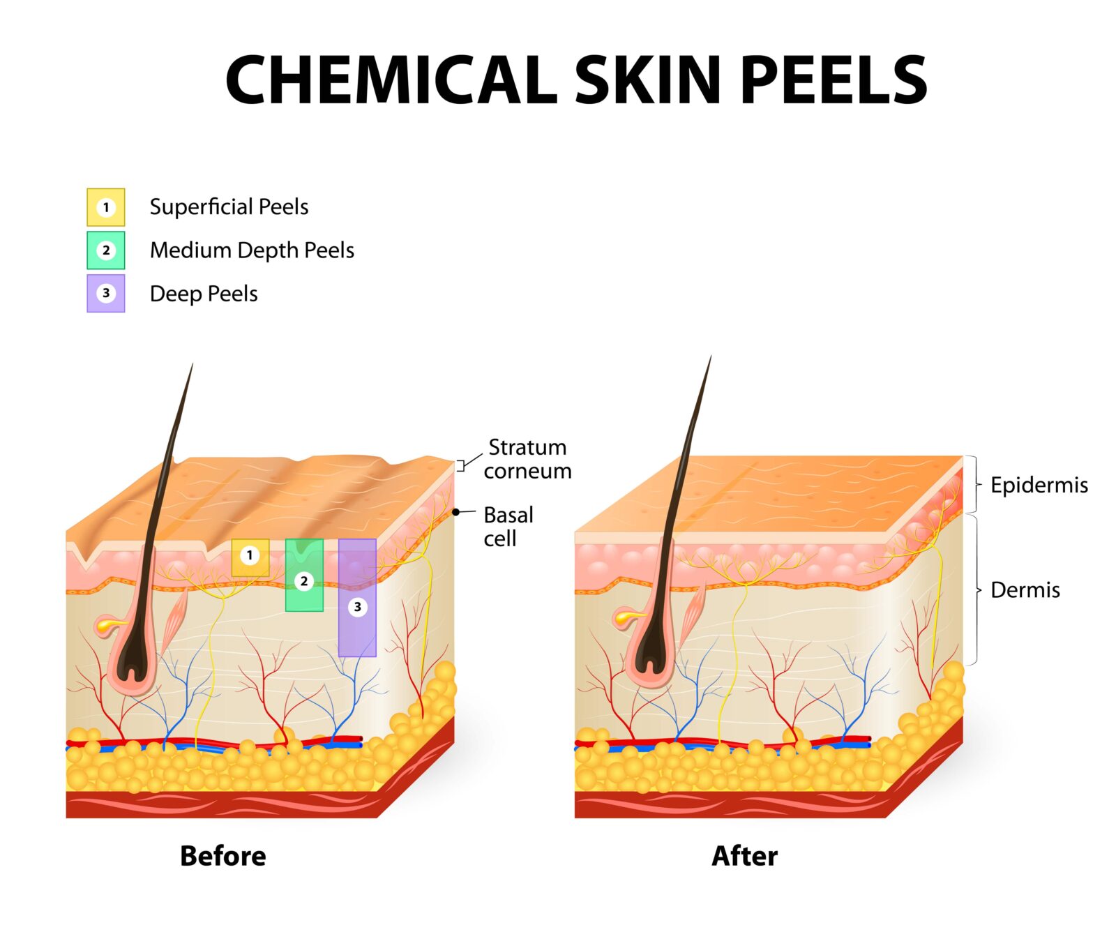 different types of chemical peels and how the affect the skin layers
