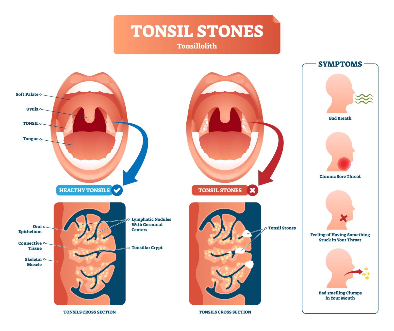 tonsil stone diagram