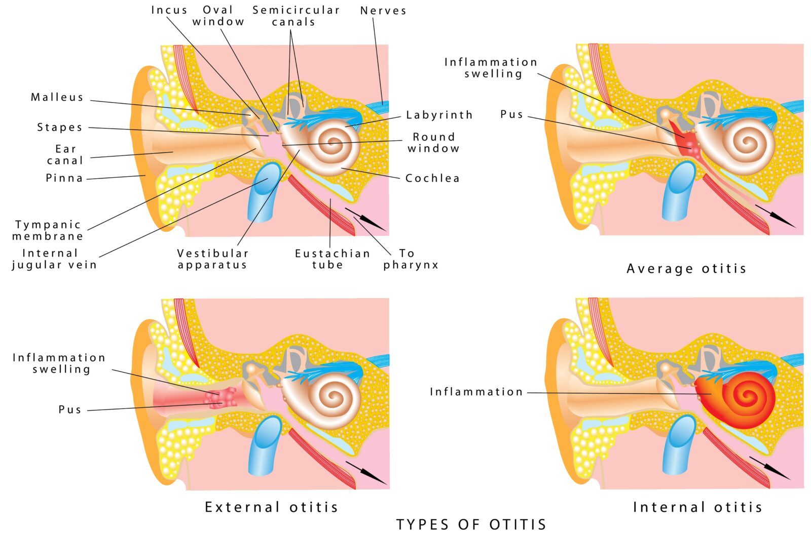 Types of otitis