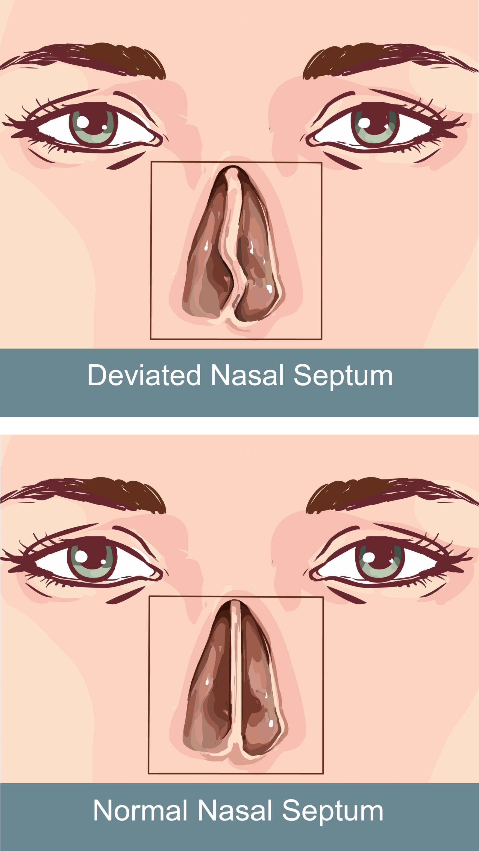 normal vs. deviated nasal septum