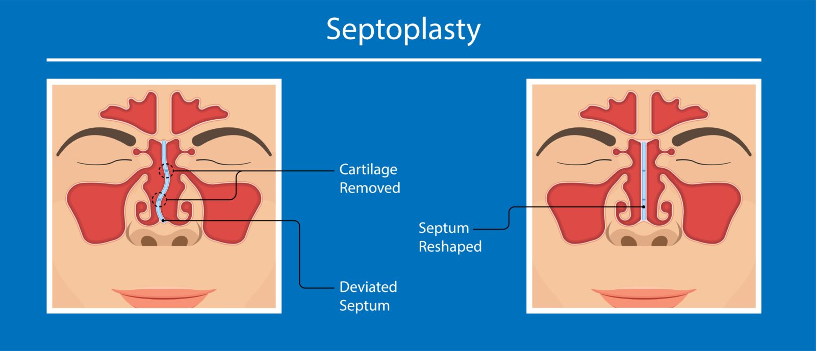 Septoplasty procedure