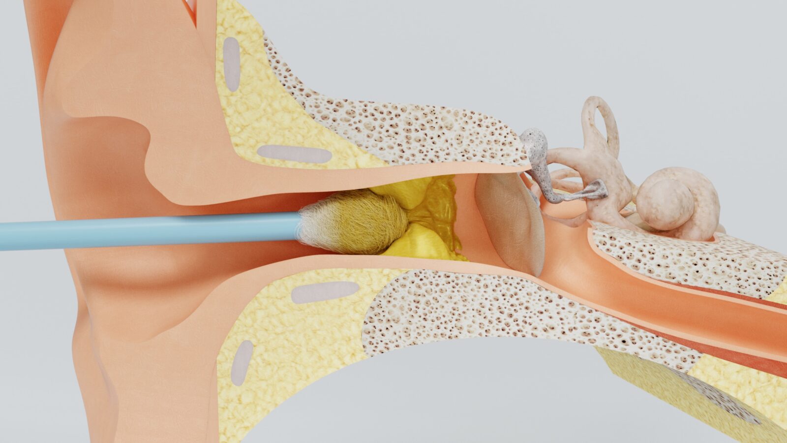earwax buildup in the ear canal