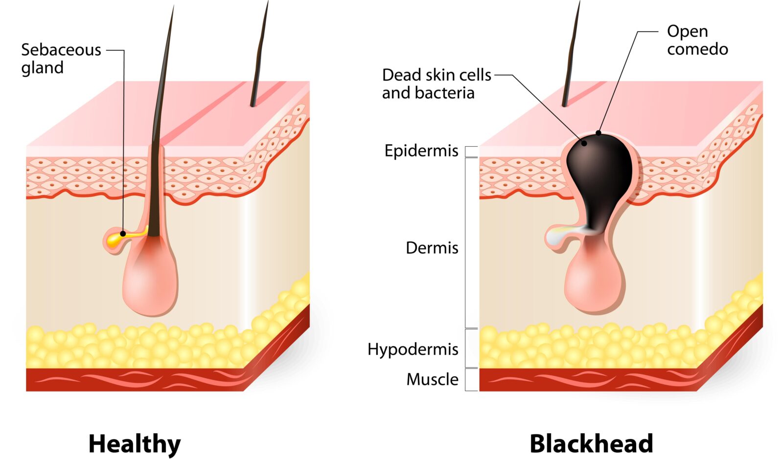 healthy skin vs skin with blackhead