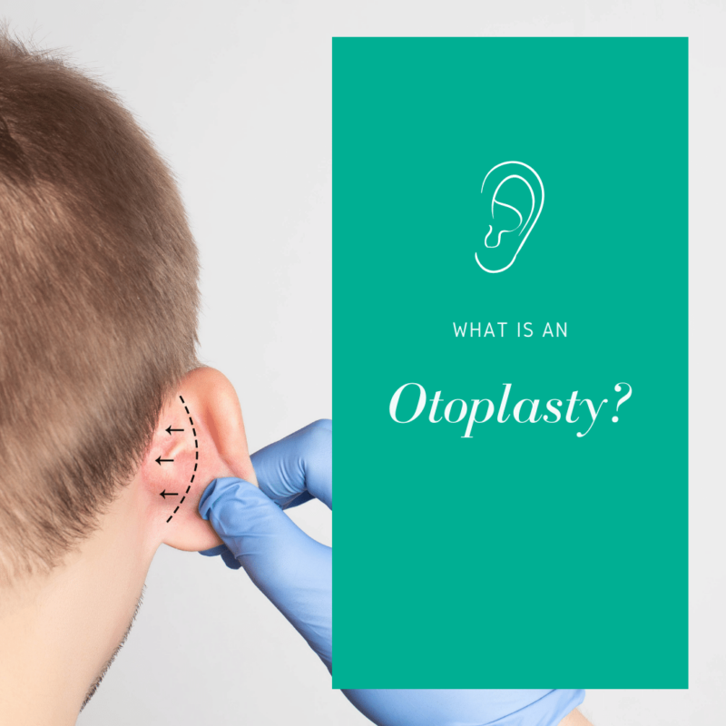 what is an otoplasty