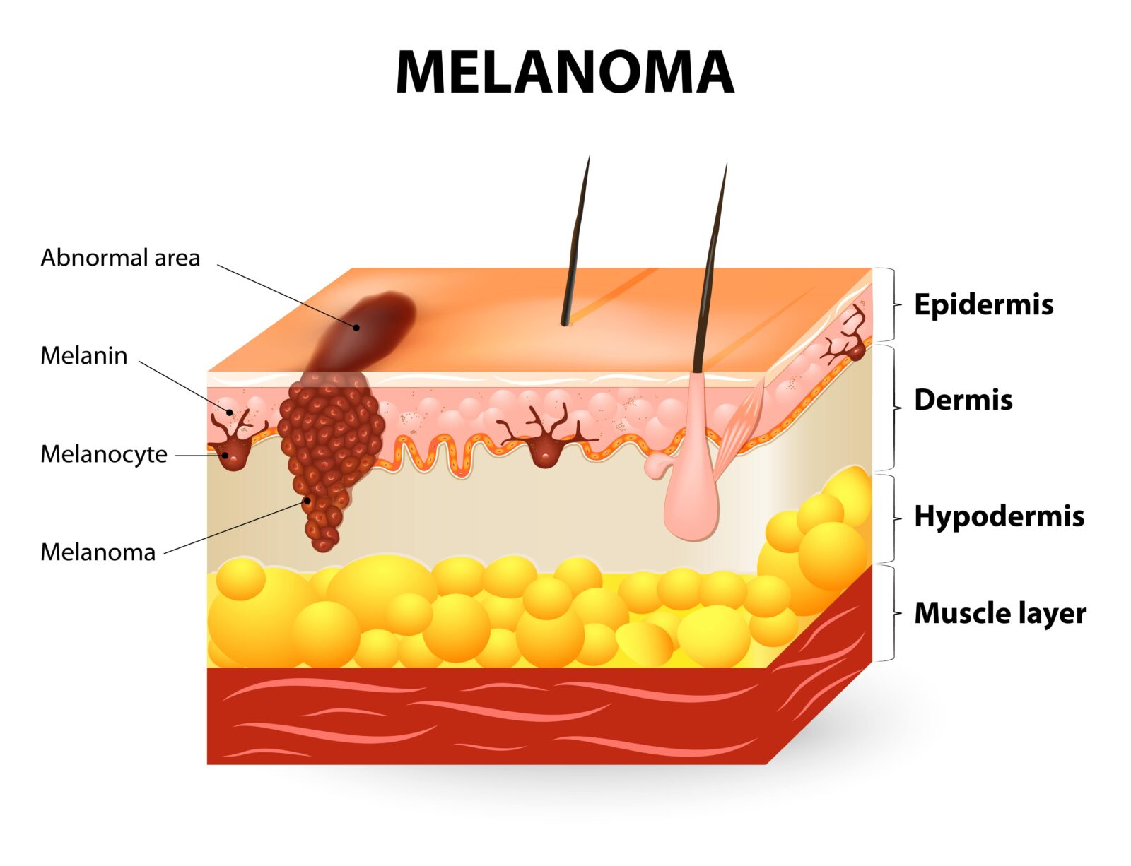 melanoma illustration of skin