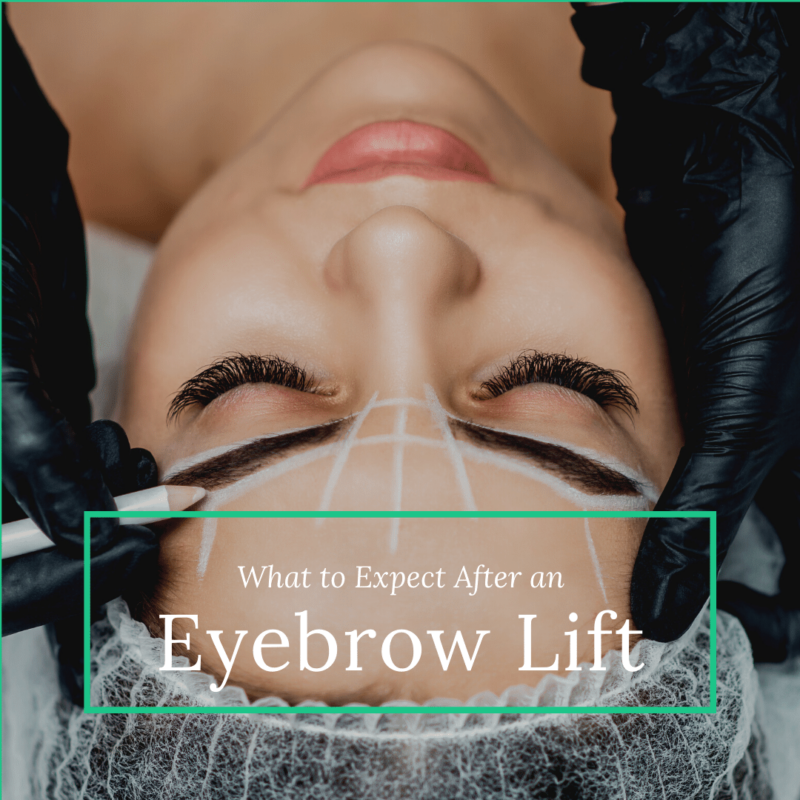 What to Expect After an eyebrow lift