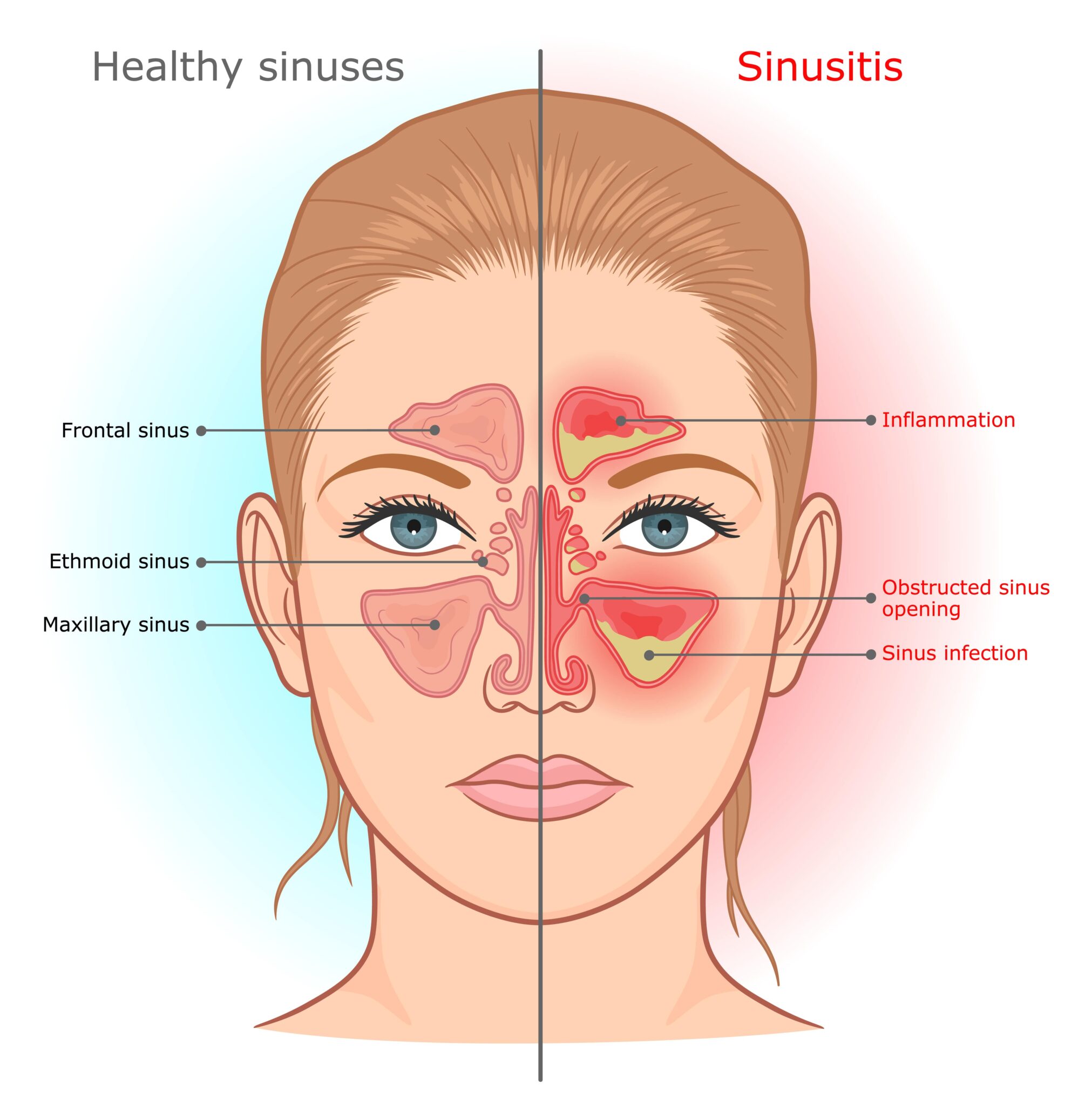 types-of-sinusitis-annapolis-and-severna-park-md