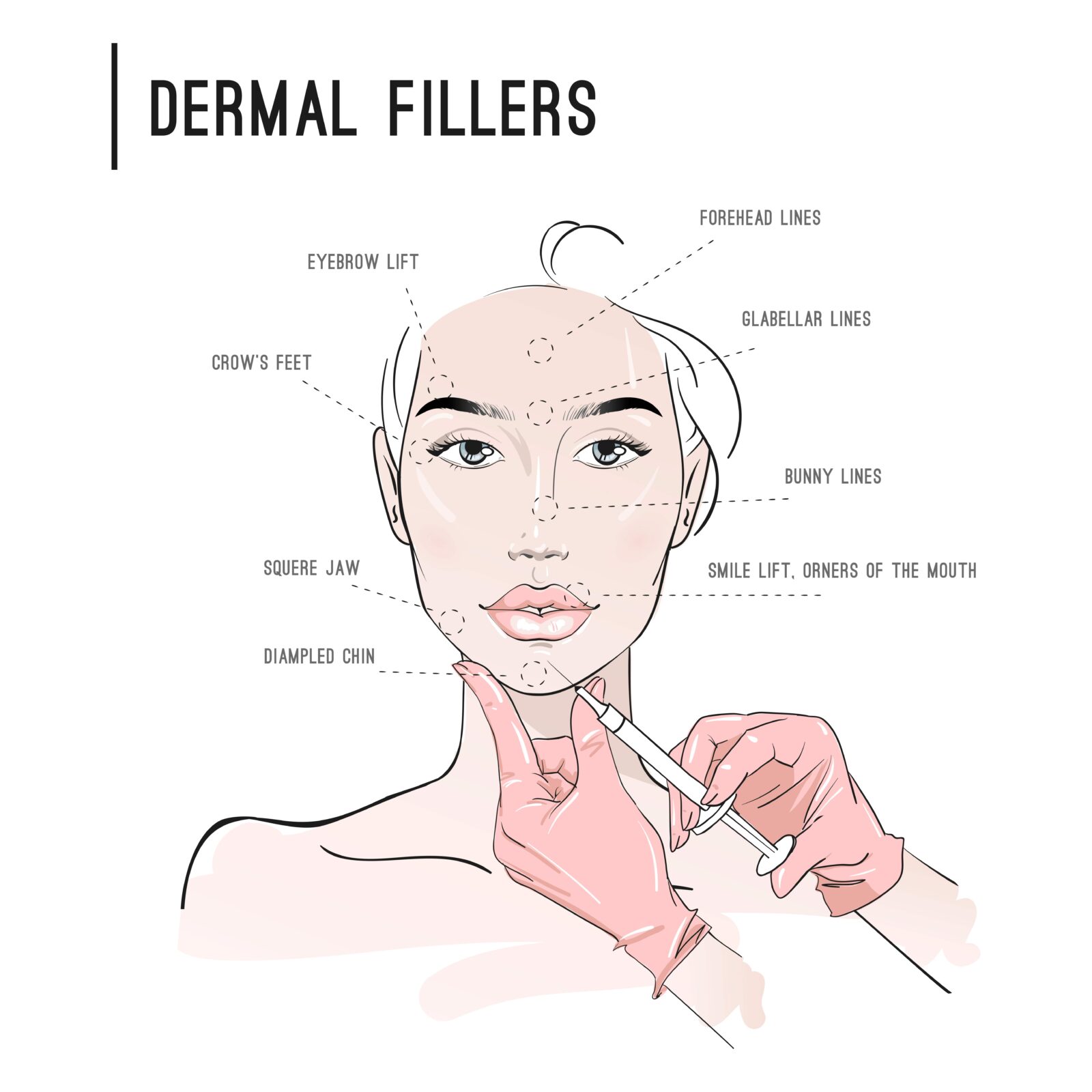 places where dermal fillers can be used