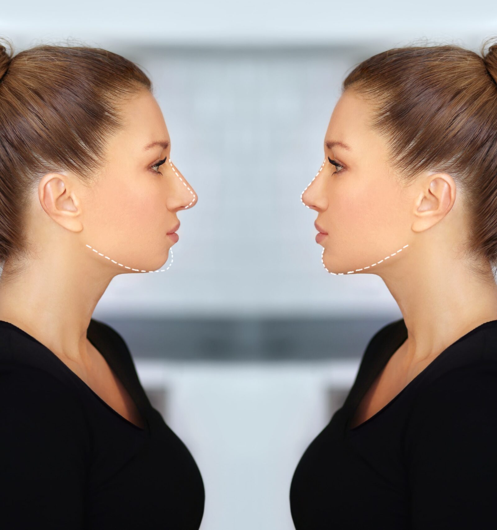 rhinoplasty and chin augmentation before and after