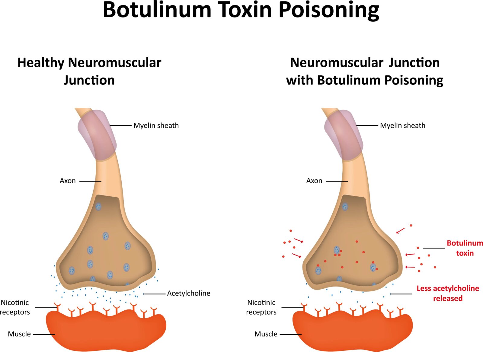 botulinum toxin poisoning