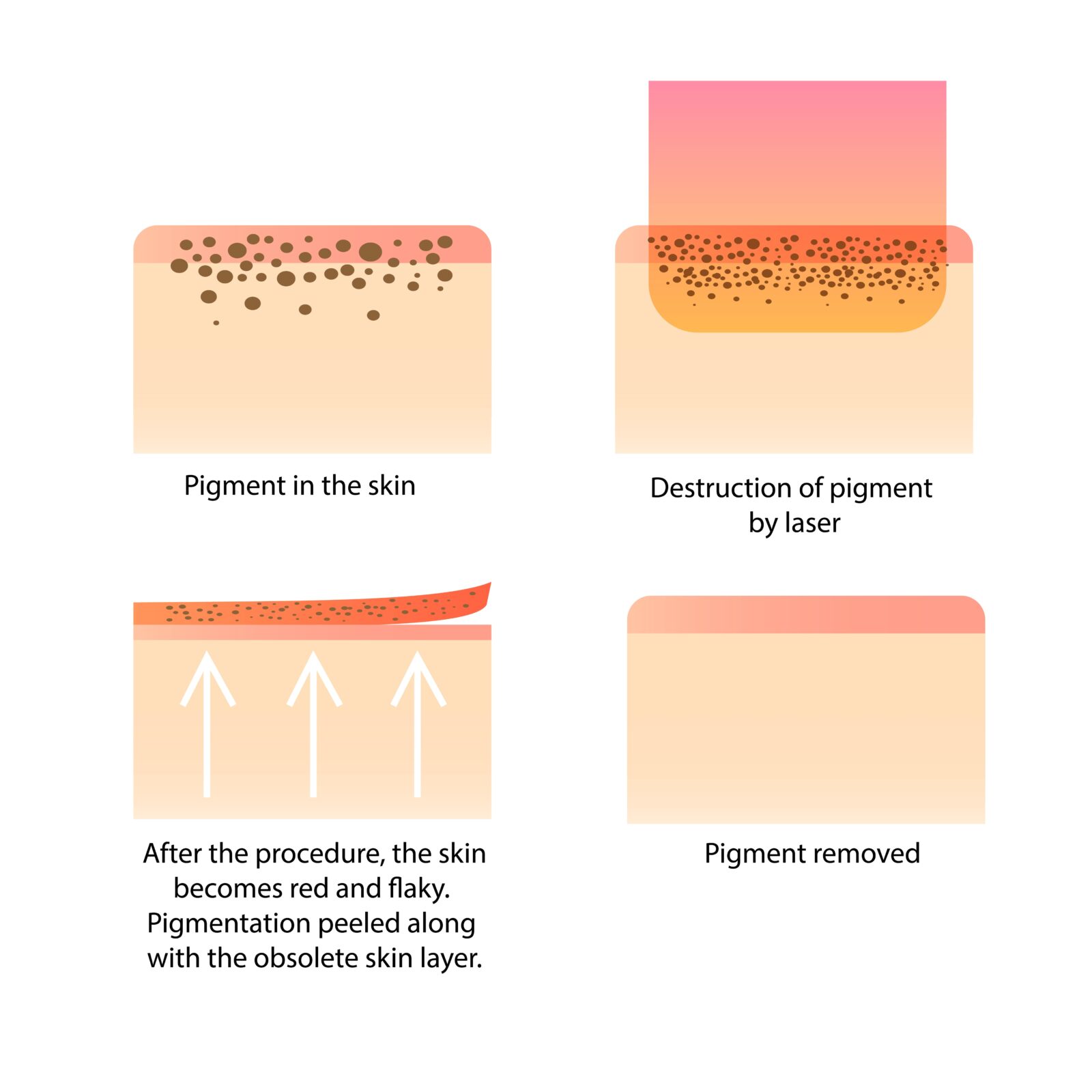 how laser treatments remove pigments from skin