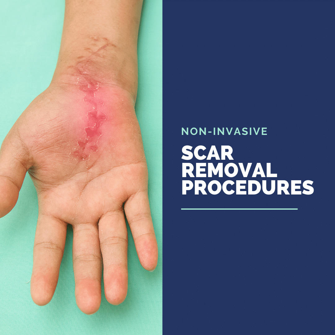 Non-Invasive scar removal procedures