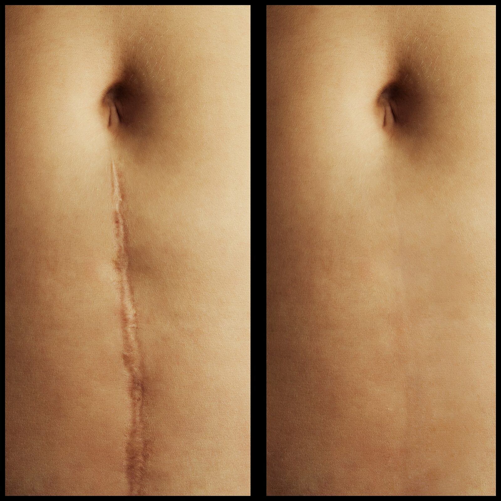 before and after scar revision surgery