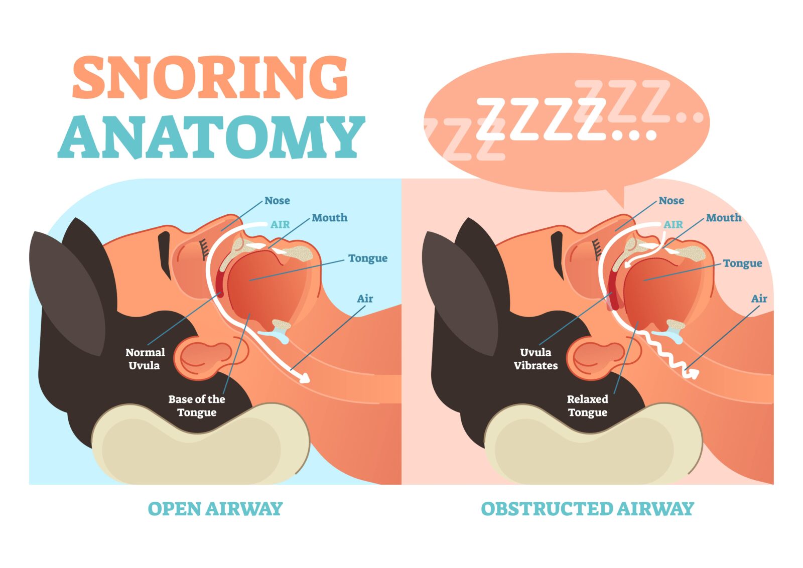 open vs. obstructed airway and how it causes snoring