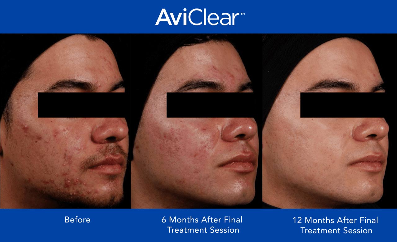before and after aviclear acne laser treatment