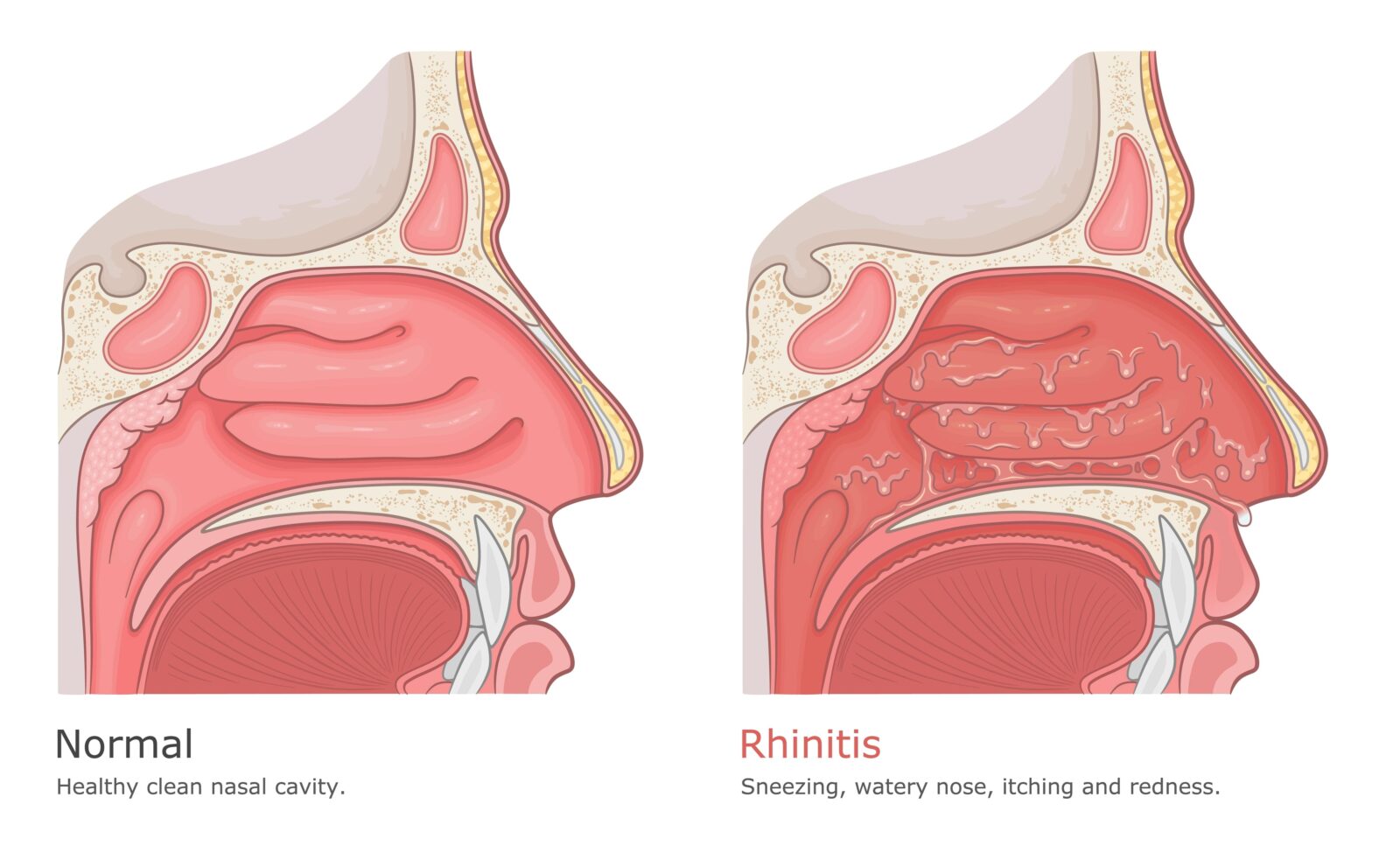 side profile of normal nasal passages vs. nasal passages affected by rhinitis