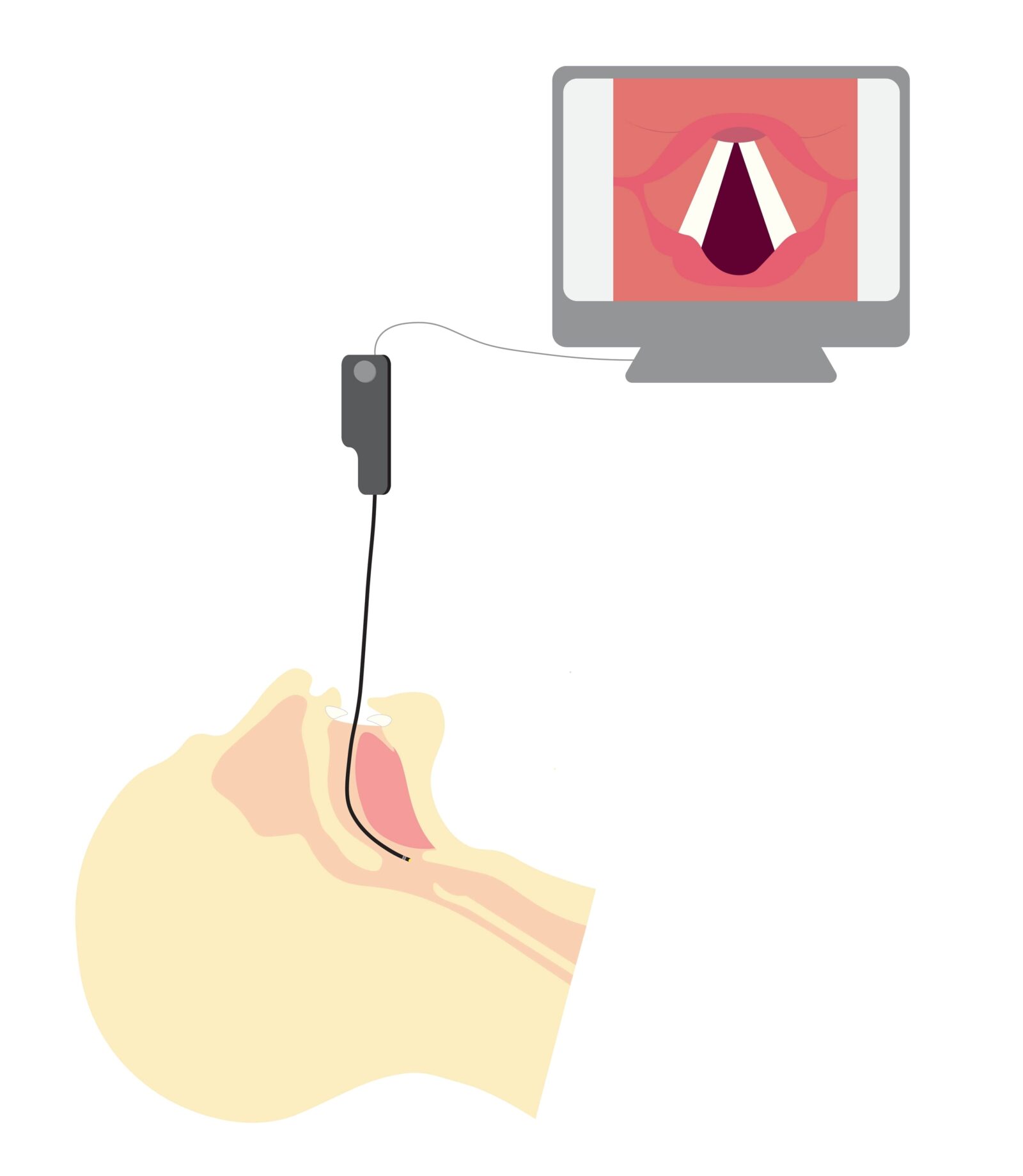 Understanding Vocal Cord Dysfunction Laryngoscopy vs. Videostroboscopy Annapolis and Severna